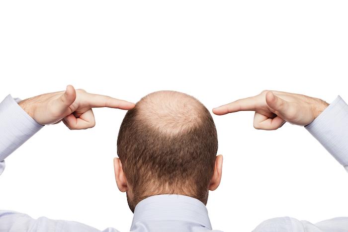 Human alopecia or hair loss - adult man hand pointing his bald head